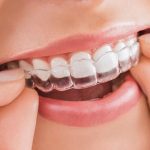 Top 10 Things to Know About Invisalign Buttons