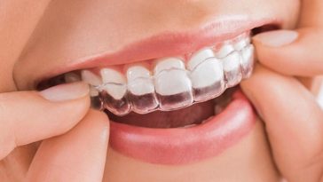 Top 10 Things to Know About Invisalign Buttons